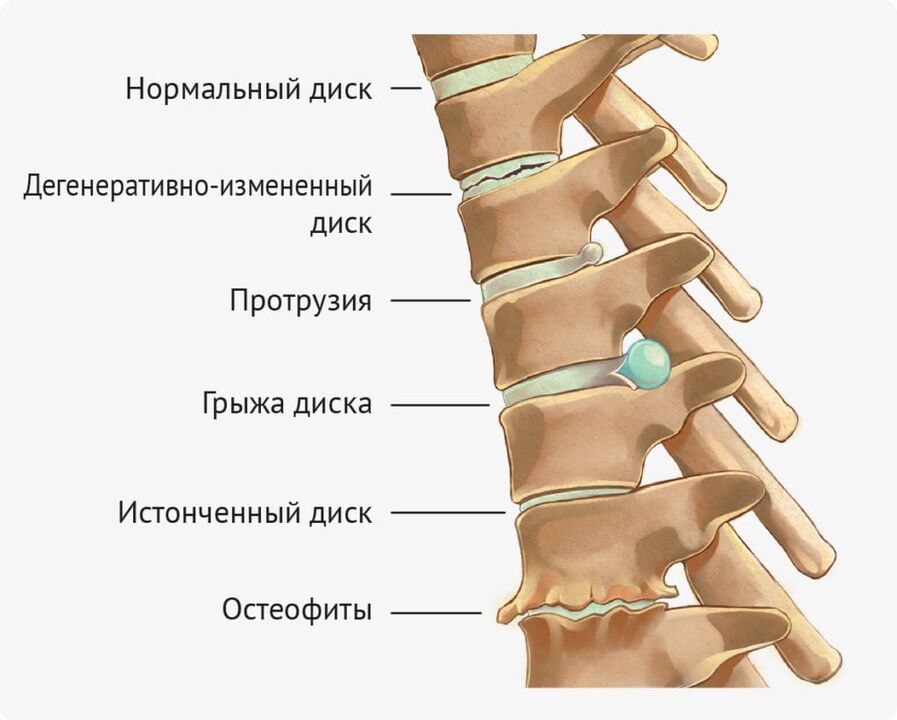 Deformität der Scheibe für die lumbale Osteochondose