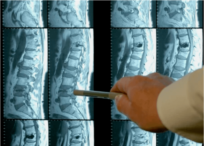 Vielfalt der Osteochondrose in der Wirbelsäule