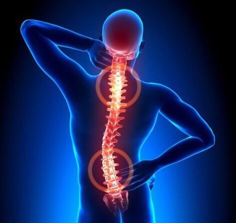 Osteochondrose der Wirbelsäule