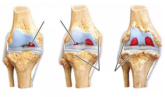 Grade-Arthrosis