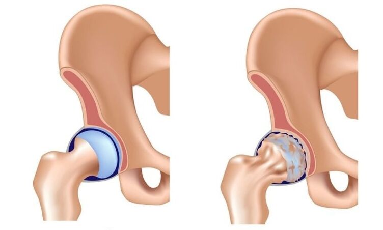 Gesundes und gemeinsames Gelenk mit Arthrose
