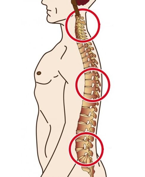 Wirbelsäulenabteilungen, in denen Osteochondose auftritt
