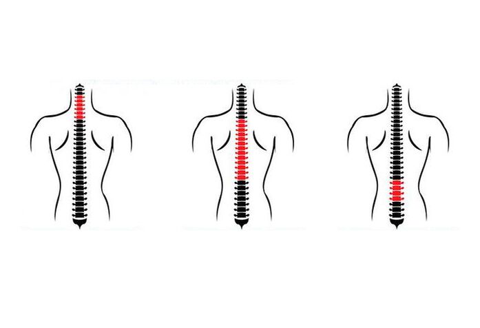 Wie sich Osteochondrose äußert