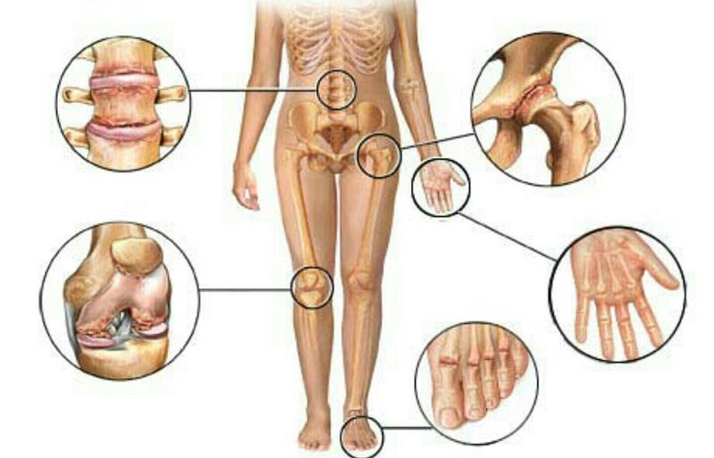 Arten und Grade der Arthrose