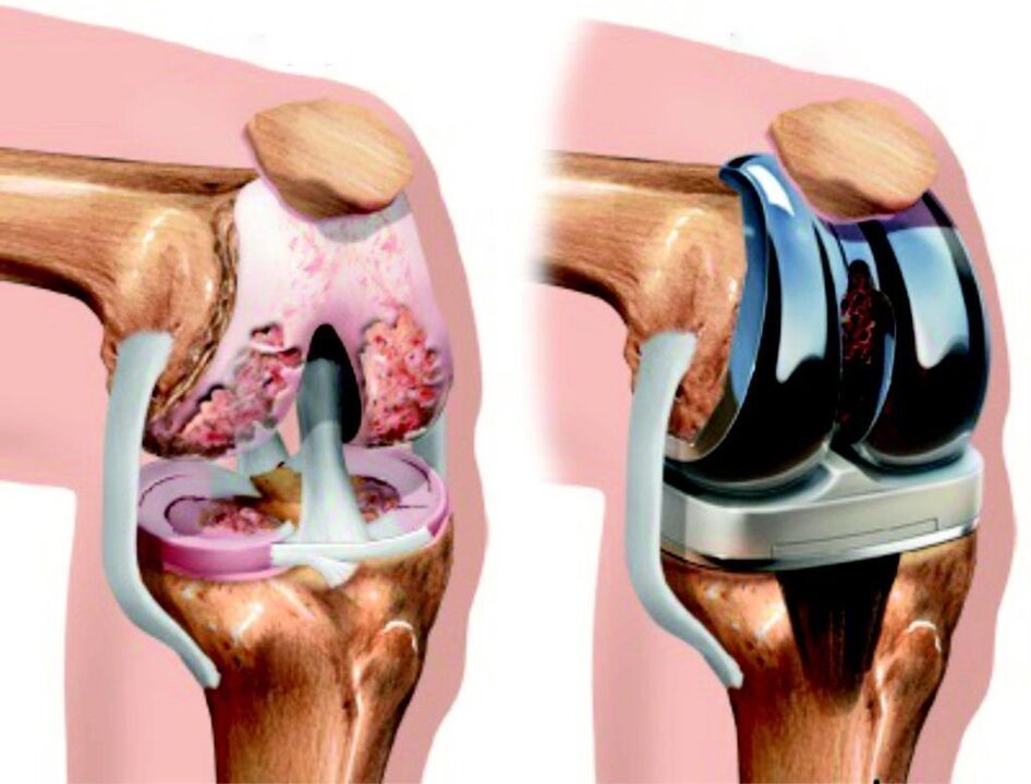 Bei einer durch Arthrose verursachten Totalschädigung des Kniegelenks ist eine Wiederherstellung durch Endoprothetik möglich