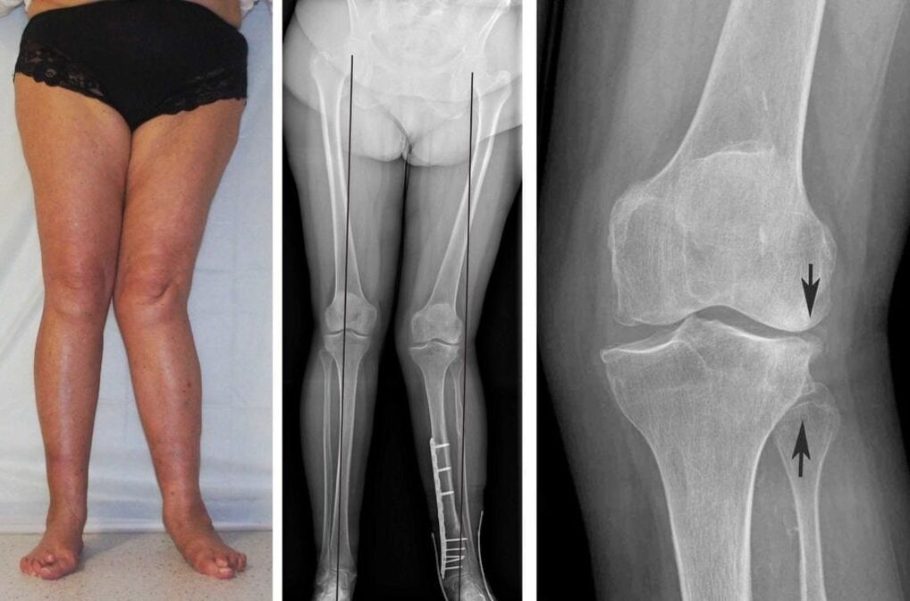 Eine fortgeschrittene Arthrose der Kniegelenke ist auch ohne Röntgenaufnahme optisch deutlich erkennbar
