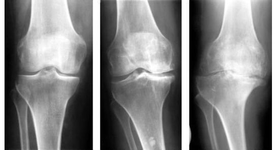 Eine obligatorische diagnostische Maßnahme zur Erkennung einer Kniearthrose ist eine Röntgenaufnahme